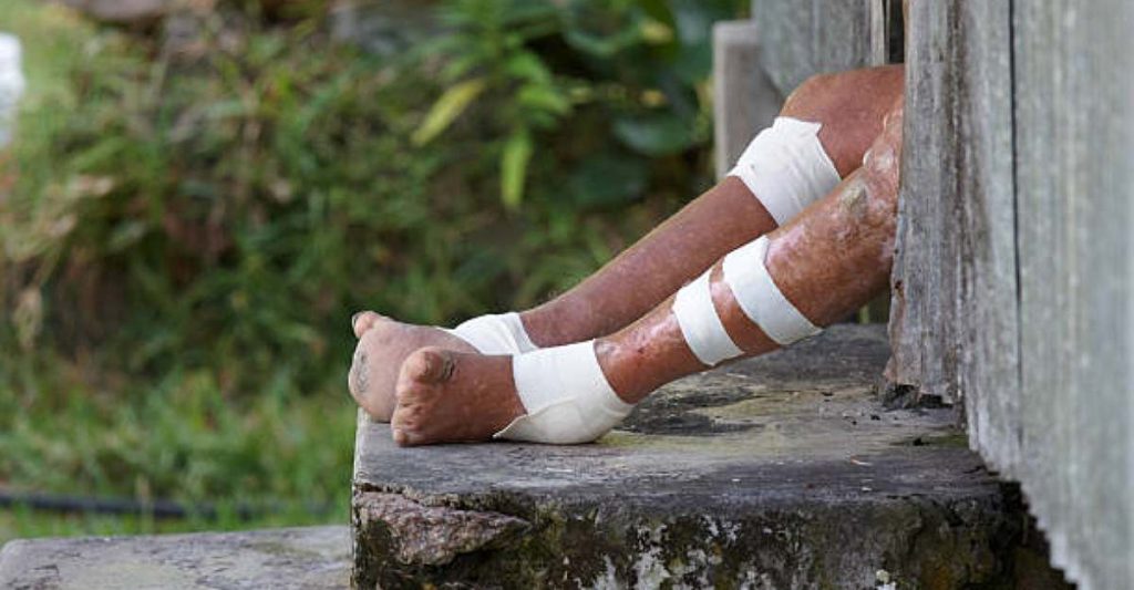 Leprosy