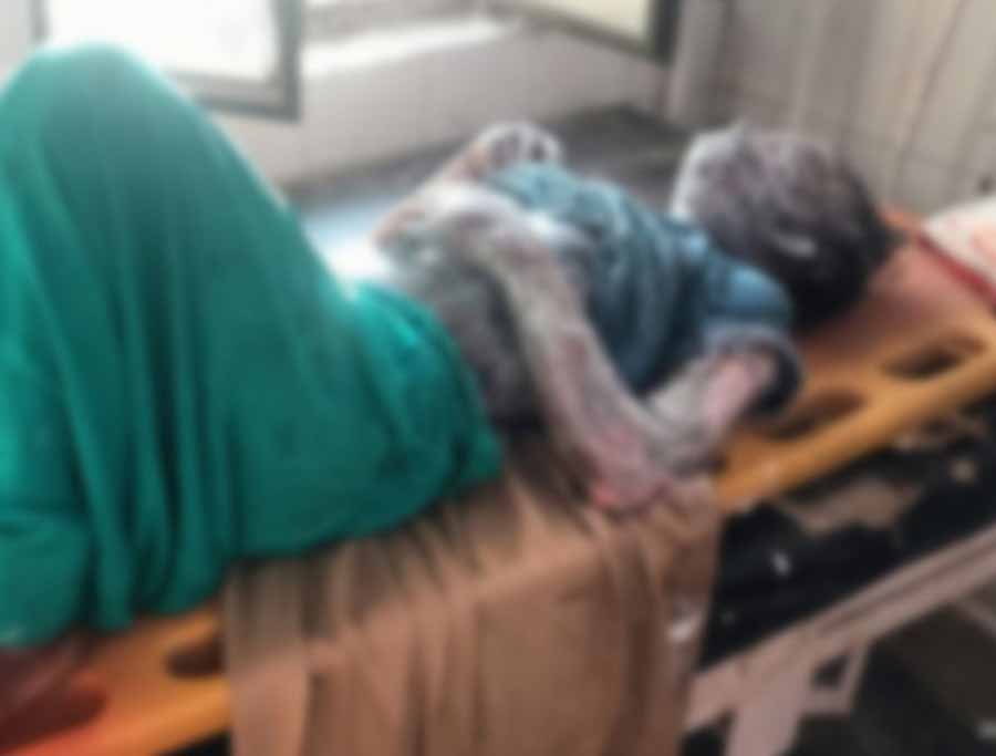 अमरोहा में हुए तेजाब हमले में झुलसी छात्रा ने उपचार के दाैरान तोड़ा दम 1 tejab1
