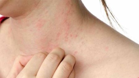 गर्मियों में स्‍कि‍न रेडनेस की समस्‍या आम है, ट्राई करें ये ट‍िप्‍स